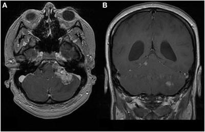 Atypical Teratoid Rhabdoid Tumor: Two Case Reports and an Analysis of Adult Cases with Implications for Pathophysiology and Treatment